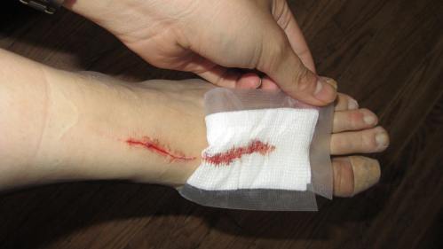 dance injury -- sliced foot